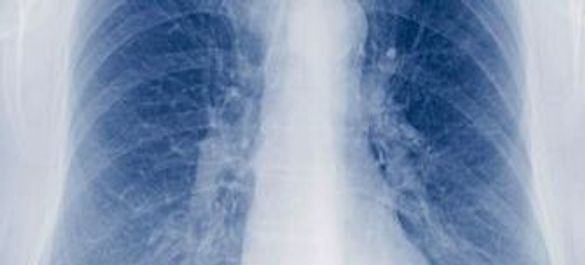 X-ray image of tuberculosis in the lungs.