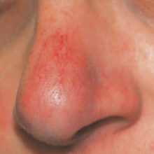 Rosacea